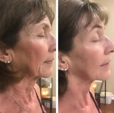 KP Corrector Cream